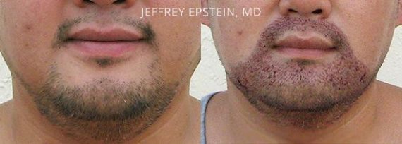 Trasplante de Pelo Facial Before and after in Miami, FL, Paciente 72390