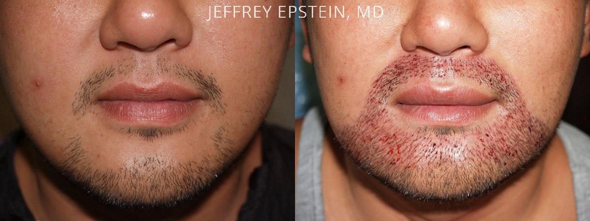 Trasplante de Pelo Facial Antes y después en Miami, FL, Paciente 72372
