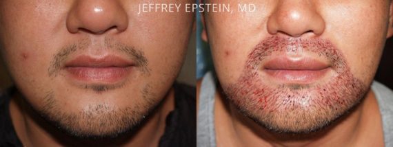 Trasplante de Pelo Facial Before and after in Miami, FL, Paciente 72372