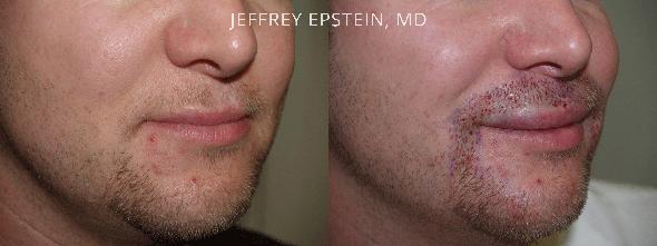 Trasplante de Pelo Facial Antes y después en Miami, FL, Paciente 72322