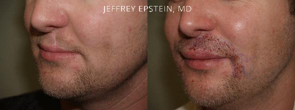 Trasplante de Pelo Facial Antes y después en Miami, FL, Paciente 72322