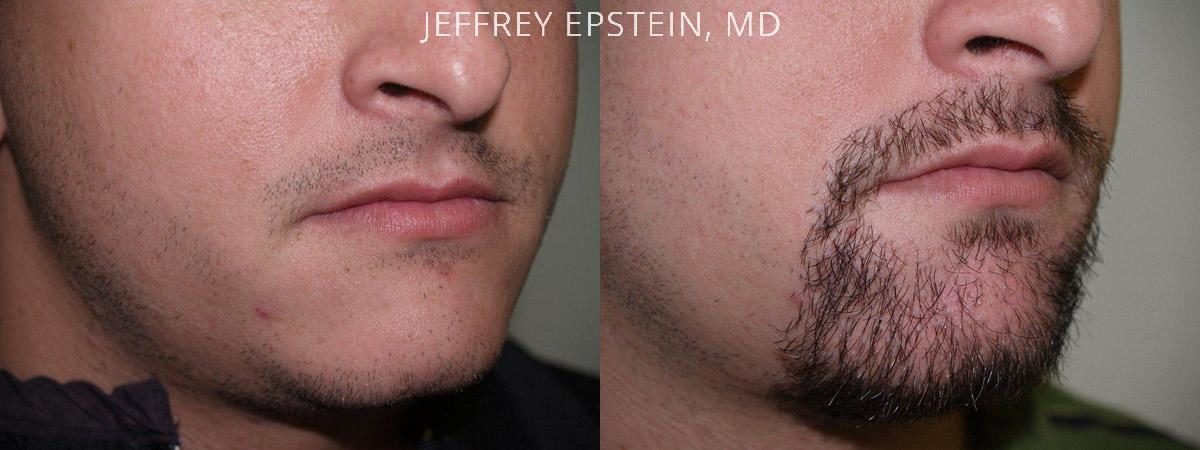 Trasplante de Pelo Facial Antes y después en Miami, FL, Paciente 72272