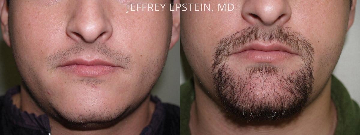 Facial Hair Transplant Before and after in Miami, FL, Paciente 36898