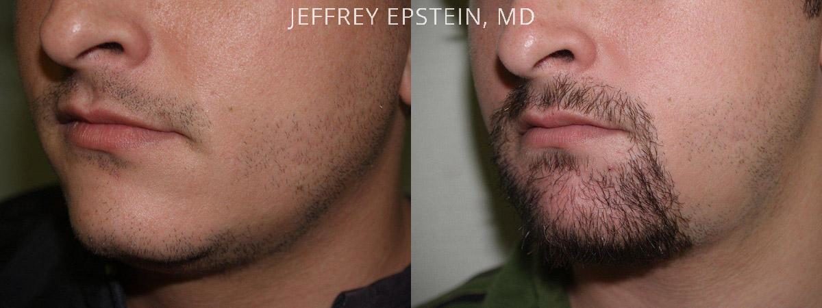 Facial Hair Transplant Before and after in Miami, FL, Paciente 36898