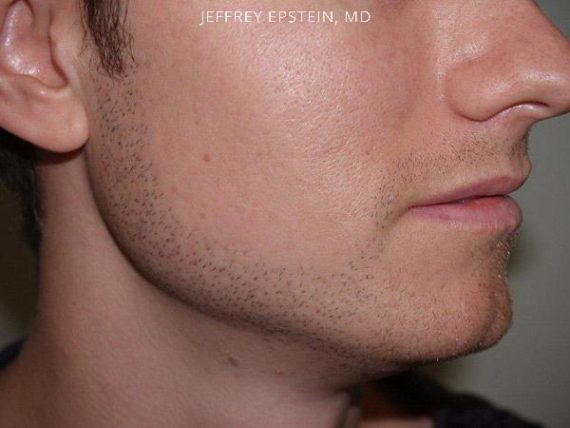 Facial Hair Transplant Before and after in Miami, FL, Paciente 36905