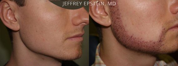 Facial Hair Transplant Before and after in Miami, FL, Paciente 36905