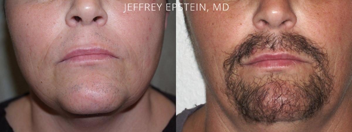 Facial Hair Transplant Before and after in Miami, FL, Paciente 36909