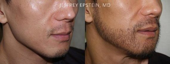 Trasplante de Pelo Facial Before and after in Miami, FL, Paciente 72112