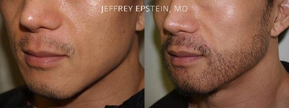 Trasplante de Pelo Facial Antes y después en Miami, FL, Paciente 72112