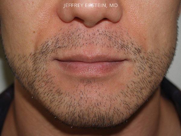 Trasplante de Pelo Facial Antes y después en Miami, FL, Paciente 72112