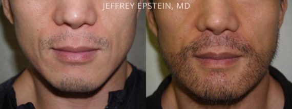 Trasplante de Pelo Facial Before and after in Miami, FL, Paciente 72112