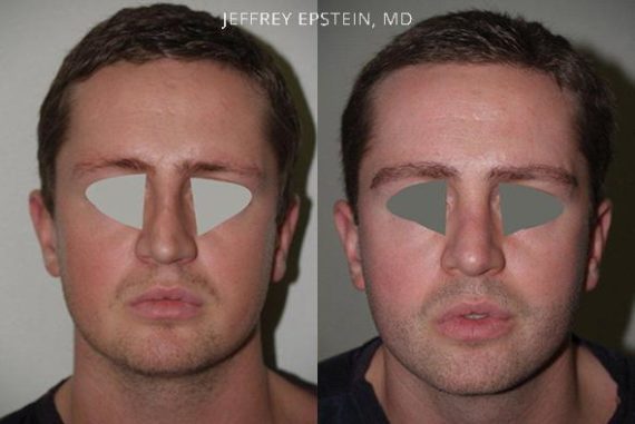 Trasplante de Pelo Facial Before and after in Miami, FL, Paciente 72090
