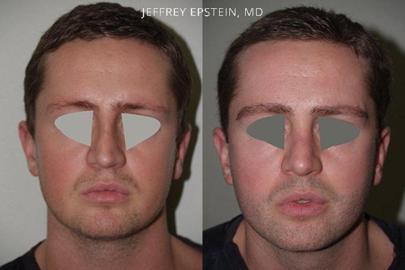Trasplante de Pelo Facial Antes y después en Miami, FL, Paciente 72090