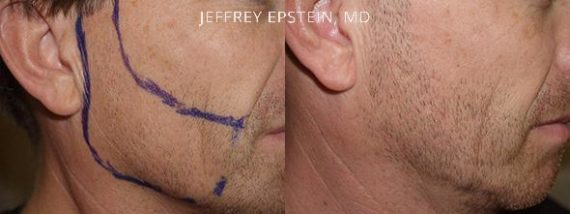 Trasplante de Pelo Facial Before and after in Miami, FL, Paciente 72073