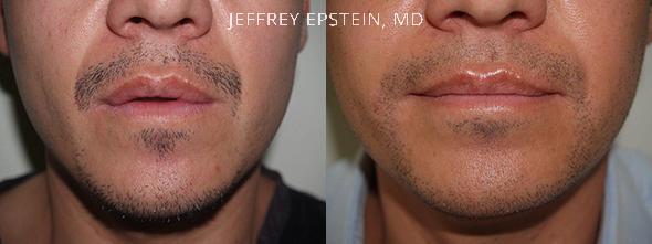 Facial Hair Transplant Before and after in Miami, FL, Paciente 36929