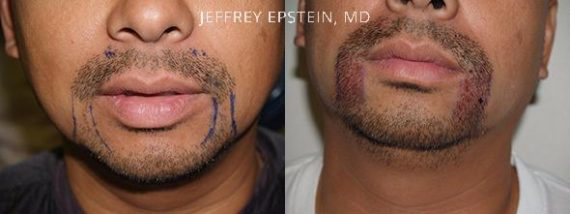 Trasplante de Pelo Facial Before and after in Miami, FL, Paciente 72051