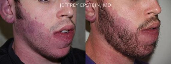 Trasplante de Pelo Facial Before and after in Miami, FL, Paciente 72024