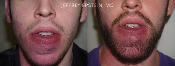 Trasplante de Pelo Facial Before and after in Miami, FL, Paciente 72024