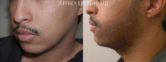 Facial Hair Transplant Before and after in Miami, FL, Paciente 36940
