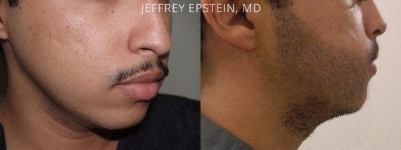 Facial Hair Transplant Before and after in Miami, FL, Paciente 36940