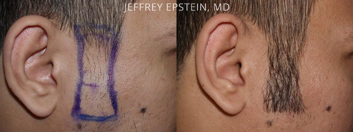 Facial Hair Transplant Before and after in Miami, FL, Paciente 36945