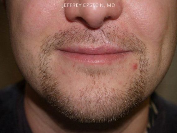 Facial Hair Transplant Before and after in Miami, FL, Paciente 36948