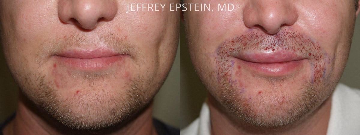 Trasplante de Pelo Facial Antes y después en Miami, FL, Paciente 71967
