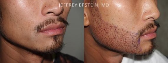 Trasplante de Pelo Facial Before and after in Miami, FL, Paciente 71900