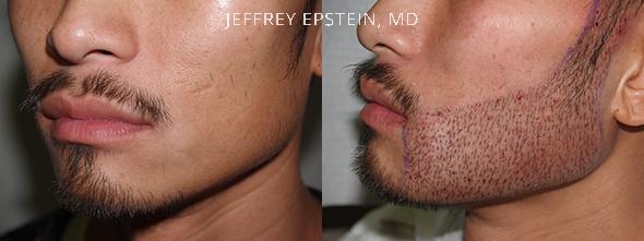 Trasplante de Pelo Facial Antes y después en Miami, FL, Paciente 71900