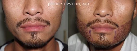 Trasplante de Pelo Facial Before and after in Miami, FL, Paciente 71900