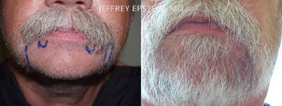 Trasplante de Pelo Facial Before and after in Miami, FL, Paciente 71883