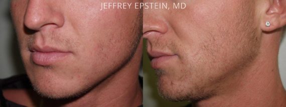 Trasplante de Pelo Facial Before and after in Miami, FL, Paciente 71830
