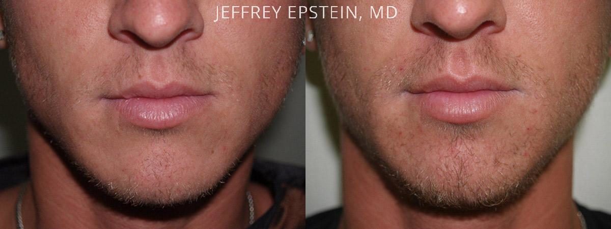 Trasplante de Pelo Facial Antes y después en Miami, FL, Paciente 71830