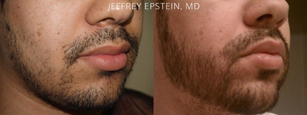 Trasplante de Pelo Facial Antes y después en Miami, FL, Paciente 71763