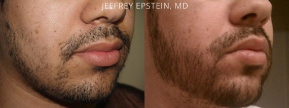 Trasplante de Pelo Facial Before and after in Miami, FL, Paciente 71763