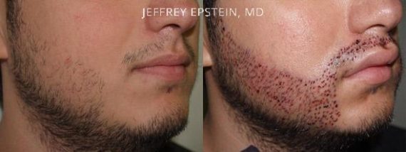 Trasplante de Pelo Facial Before and after in Miami, FL, Paciente 71698