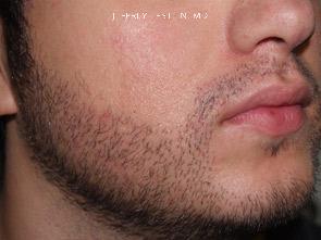 Trasplante de Pelo Facial Antes y después en Miami, FL, Paciente 71698
