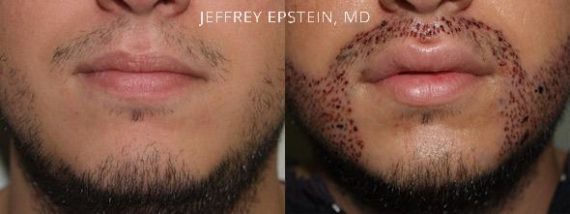 Trasplante de Pelo Facial Before and after in Miami, FL, Paciente 71698