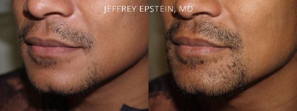 Trasplante de Pelo Facial Antes y después en Miami, FL, Paciente 71638