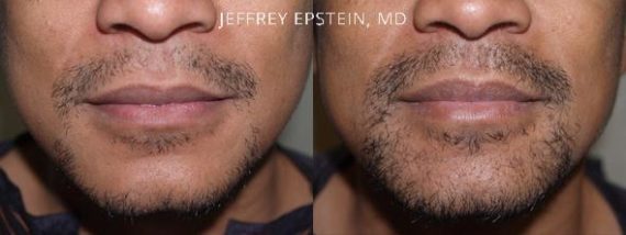 Trasplante de Pelo Facial Before and after in Miami, FL, Paciente 71638