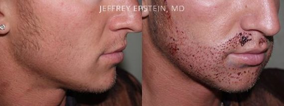 Trasplante de Pelo Facial Before and after in Miami, FL, Paciente 71605