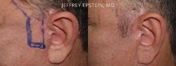 Facial Hair Transplant Before and after in Miami, FL, Paciente 37002