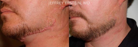 Facial Hair Transplant Before and after in Miami, FL, Paciente 37005
