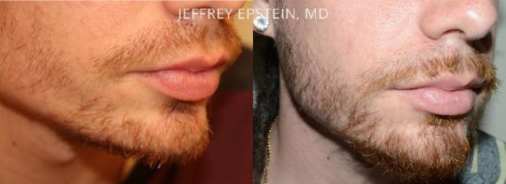 Trasplante de Pelo Facial Before and after in Miami, FL, Paciente 71562