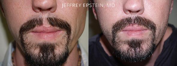 Facial Hair Transplant Before and after in Miami, FL, Paciente 37013