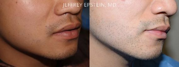 Facial Hair Before and after in Miami, FL, Paciente 37018