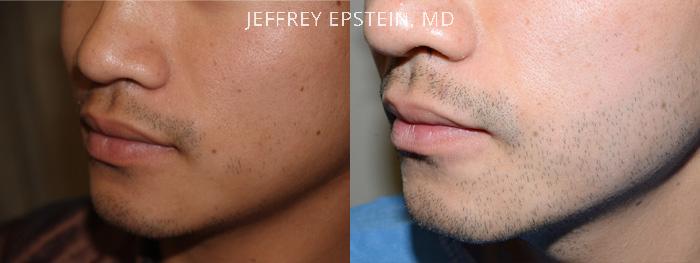 Facial Hair Transplant Before and after in Miami, FL, Paciente 37018