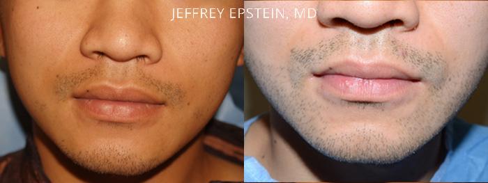 Facial Hair Transplant Before and after in Miami, FL, Paciente 37018