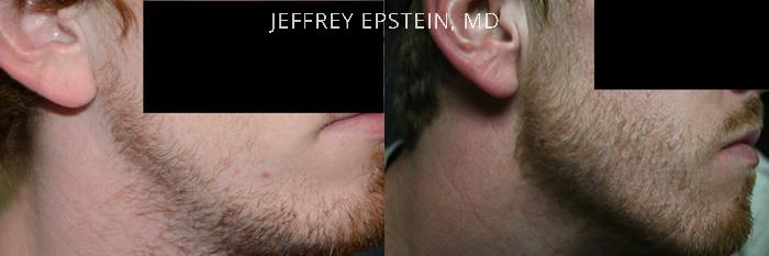 Facial Hair Transplant Before and after in Miami, FL, Paciente 37025