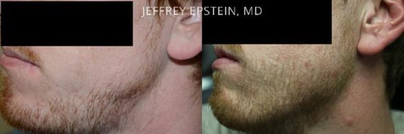 Trasplante de Pelo Facial Before and after in Miami, FL, Paciente 71445